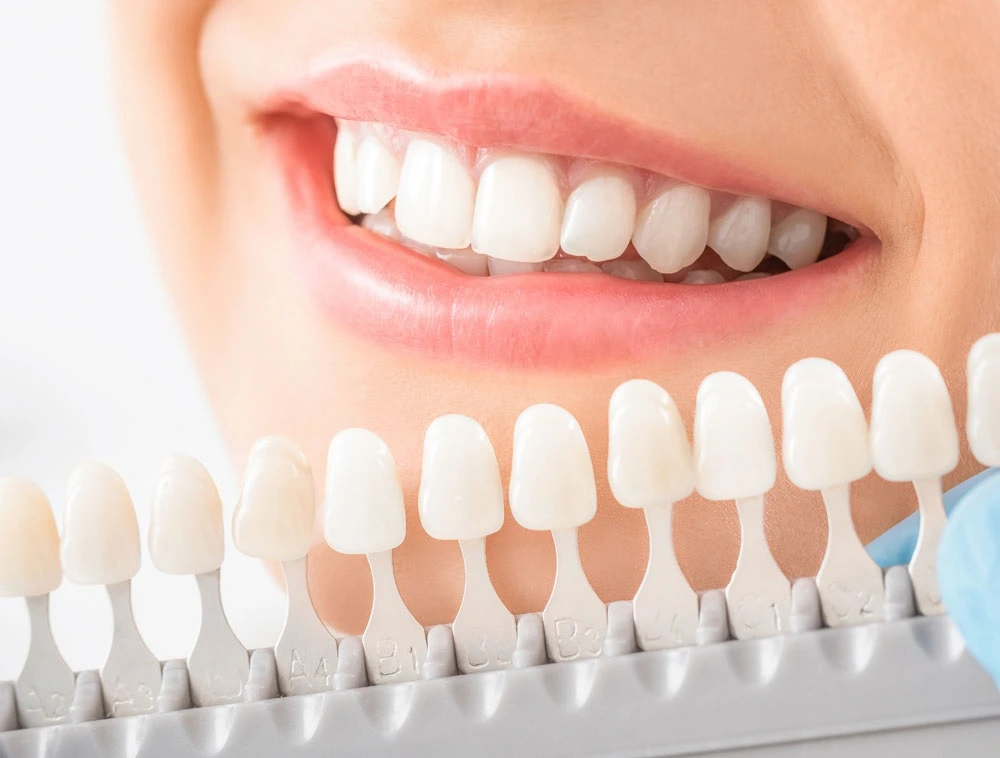 dental veneer specialist near me
