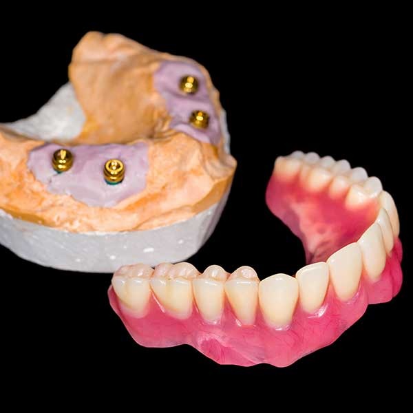 who is eligible for same day dental implants